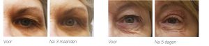 jett plasma lift