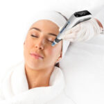 Microneedling en huidverbetering in Landgraaf & Parkstad