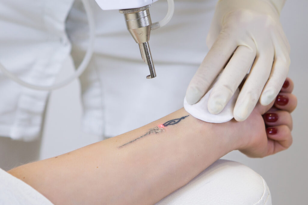 Tatoeage verwijderen met pico laser; veilig en effectief
