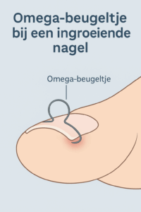 Ingroeiende teennagels? Een omega-beugeltje biedt verlichting