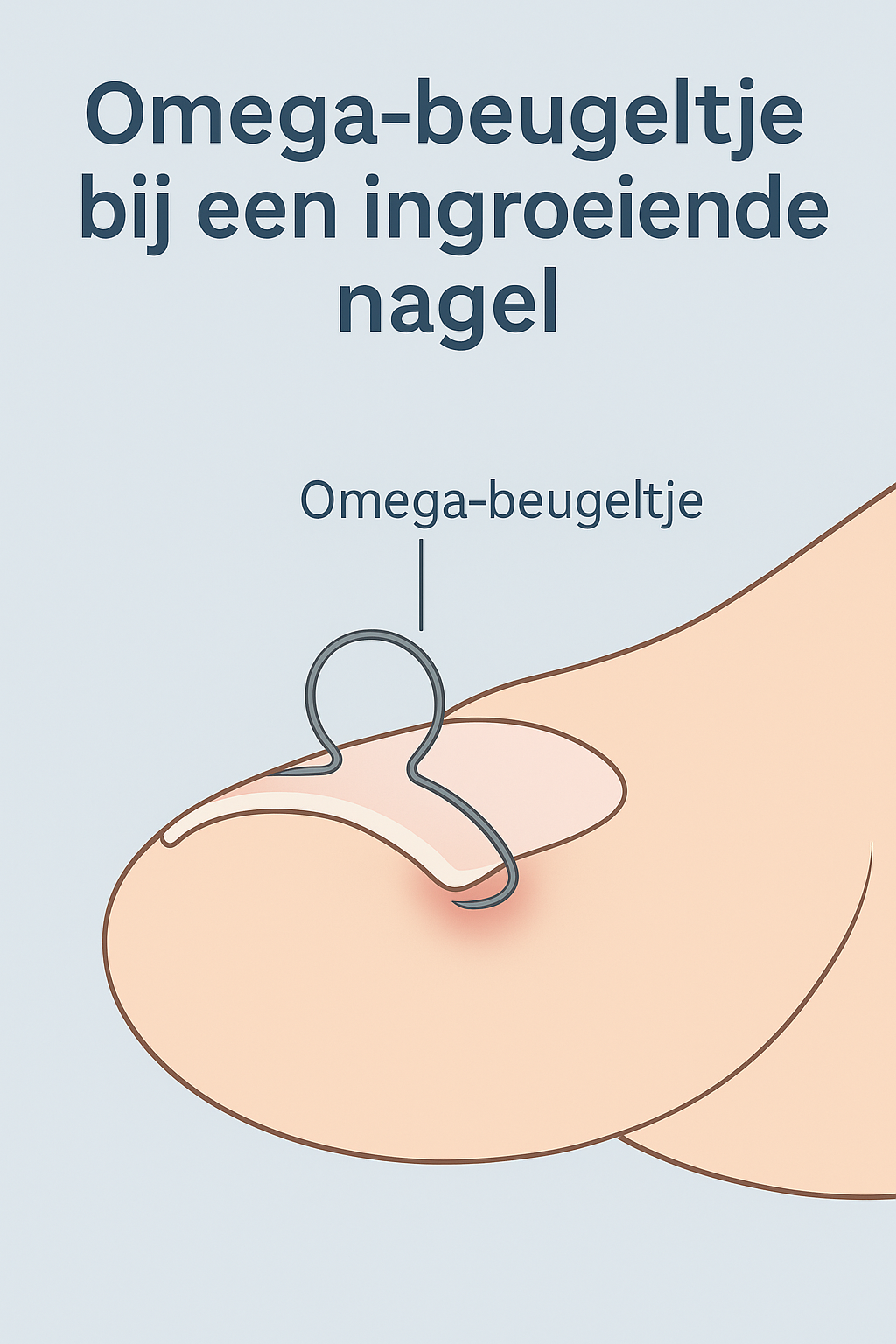 Ingroeiende teennagels? Een omega-beugeltje biedt verlichting