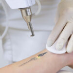 Tatoeage laseren