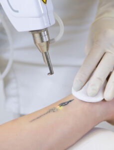 Tatoeage laseren