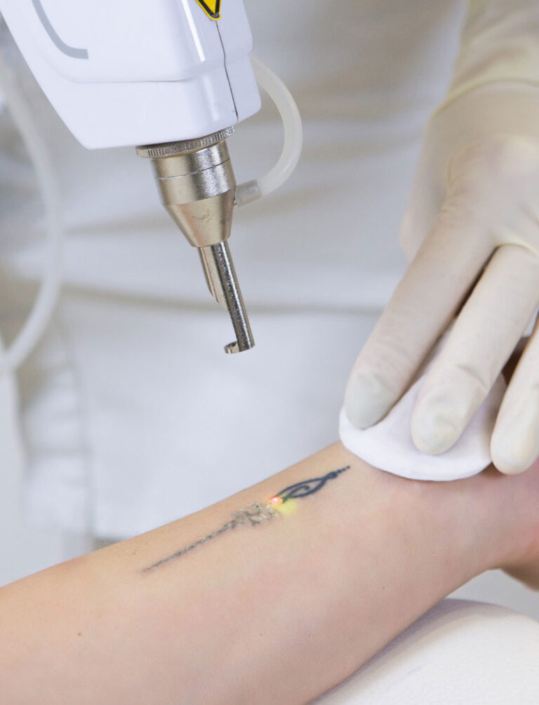 Tatoeage laseren